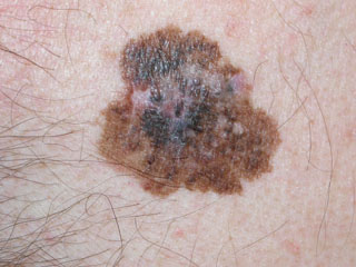 Above: A melanoma skin lesion on the chest of a 45-year-old male patient. The lesion measures 1.2 inches by 1.6 inches. Photo courtesy Dr. Timothy Johnson.