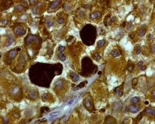 Above: This microscope image shows melanoma cells from a tumor, magnified 600 times. The three large, dark-brown cells contain high levels of the pigment melanin. Photo courtesy Mark Shackleton.