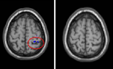 The circled portion of the older adult' brain on the left indicates the cross-talk between the two hemispheres that is not apparent in the younger brain on the right. (Image courtesy Rachael Seidler.)