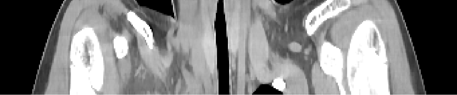 An image slice from a lung CT scan done using the new "model-based image reconstruction" technique, which could enable images with finer resolution at current X-ray doses, or with today's resolution, but using one-fourth of the X-ray radiation. Credit: Jeffrey Fessler