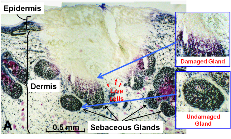A laser developed at the University of Michigan can selectively target and damage sebaceous glands, which are known to play a role in acne. Credit: Mohammed Islam 