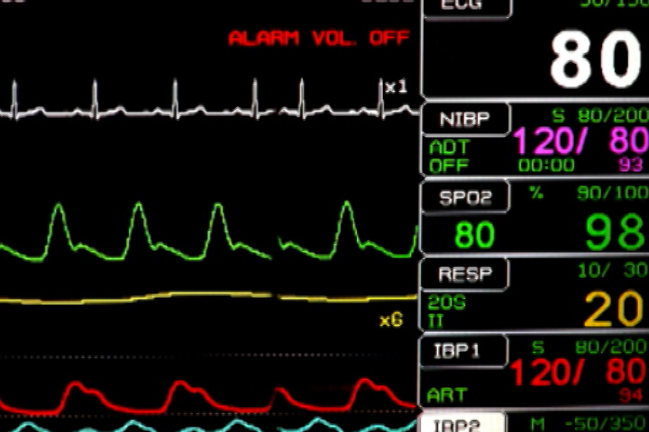 Subtle markers of heart damage hidden in plain sight among hours of EKG recordings could help doctors identify which heart attack patients are at high risk of dying soon.