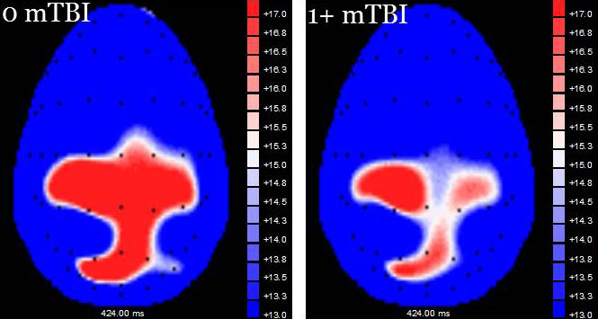 The photos compare images of two brains, one with and without head injury. The red areas indicates electrical activity in response to the task researchers asked study participants to perform, and non-injured brains show more red, thus more electrical activity during the task. Image courtesy of Steven Broglio