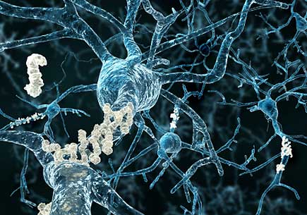  Amyloid plaques on axons of neurons affected by Alzheimer's disease. (stock image)