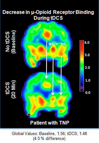 The figure above shows the brain of a chronic pain patient before and during electrical stimulation to induce pain relief. The areas in red represent the relative number of free mu-opioid receptors, the main target of pharmaceutical opiates. They found a decrease in availability of those receptors during electrical stimulation. The results indicate for the first time the active release of local mu-opioid, a powerful substance in the brain that, when binds to the receptor, changes pain perception. 