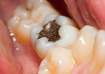 Close-up photo of a tooth with an amalgam filling. (stock image)