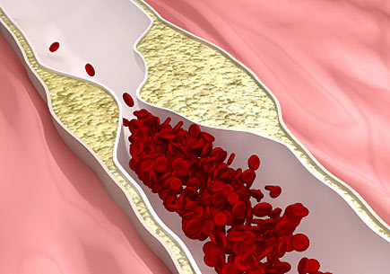3D rendering of Atherosclerosis disease (clogged arteries). (stock image)