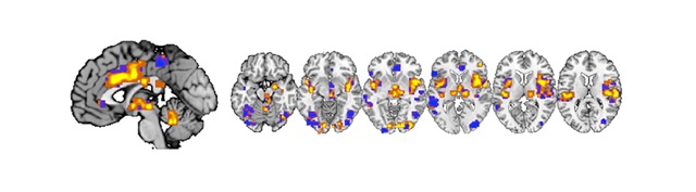 Neurologic signature for physical pain across multiple systems. Image courtesy: Tor Wager, Colorado University