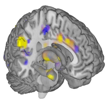  Neurologic signature for physical pain, courtesy of Tor Wager, Colorado University