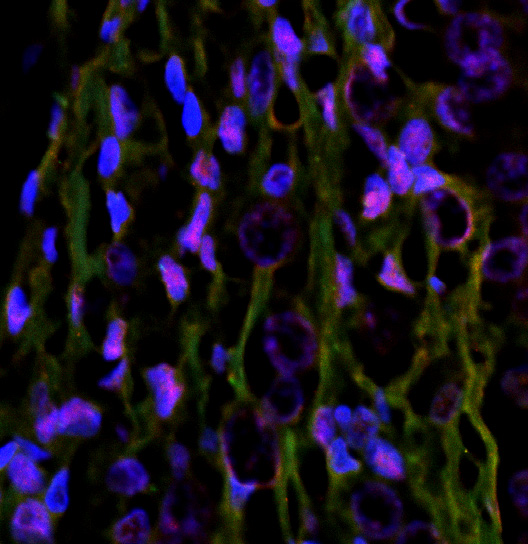 Prostate cancer cells, after interacting with normal wound healing cells have become more invasive and more able to metastasize.