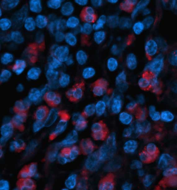 Tumor cells secrete signals that call in wound healing cells to the tumor site. In the process, the normal wound healing cells make the tumor cells more aggressive and able to metastasize.