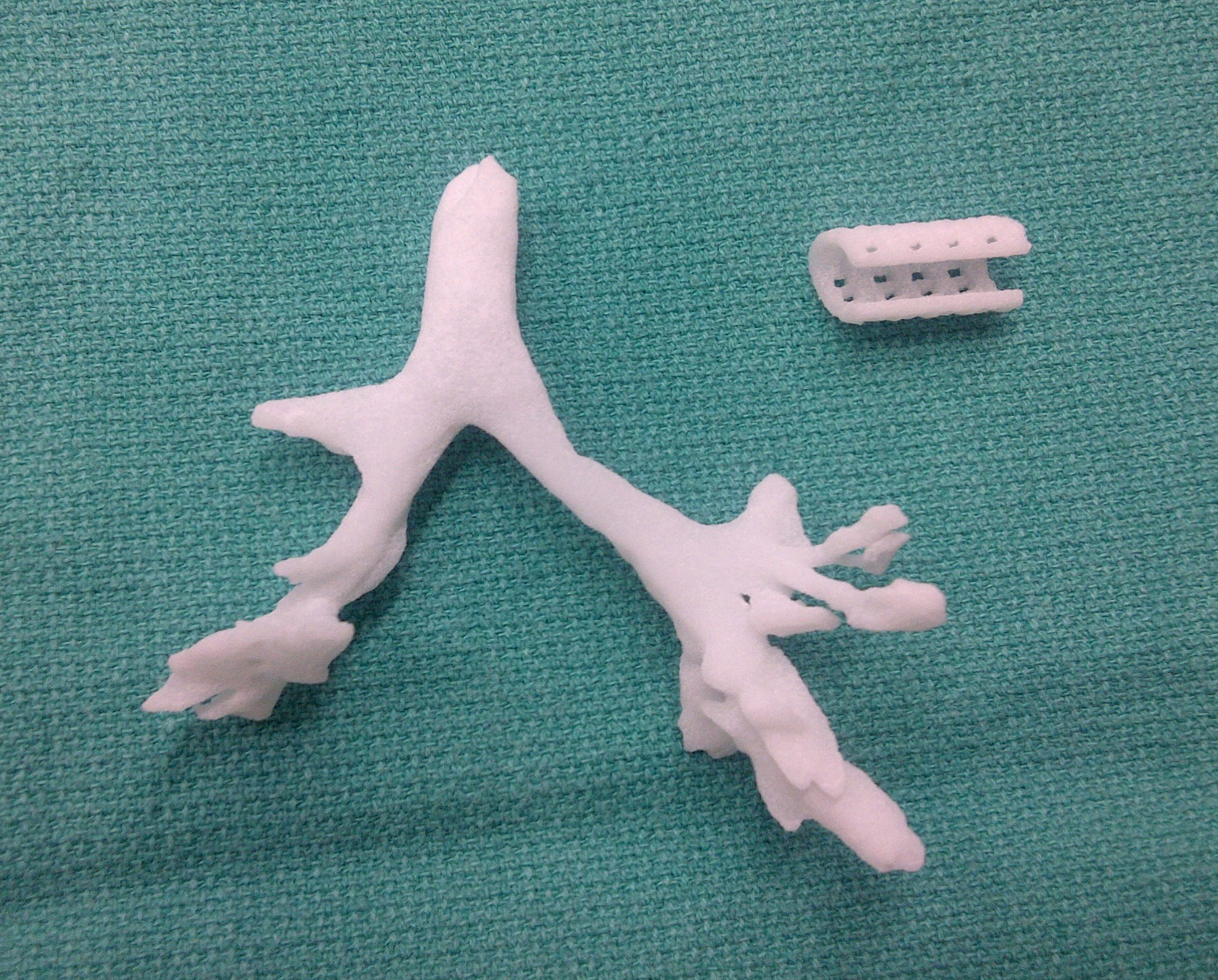 A cast made of a baby's trachea and the splint fitted on the bronchus.