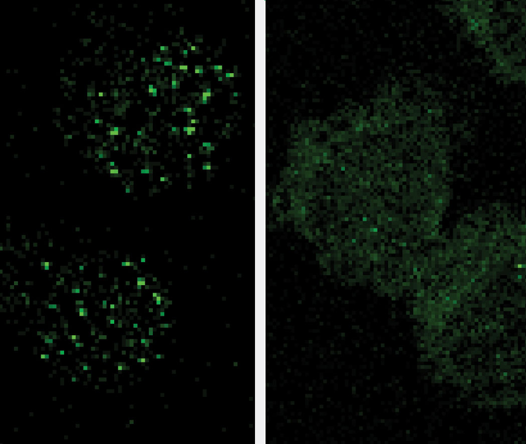 A comparison of cells from twin siblings, one with the disease and one without. The left image show the nuclei of two healthy cells. Telomeres are tagged a florescent green and clearly visible. The right image shows the nuclei of two unhealthy calls. Green tagged telomeres are blurred and nonexistent. Image credit: Jayakrishnan Nandakumar