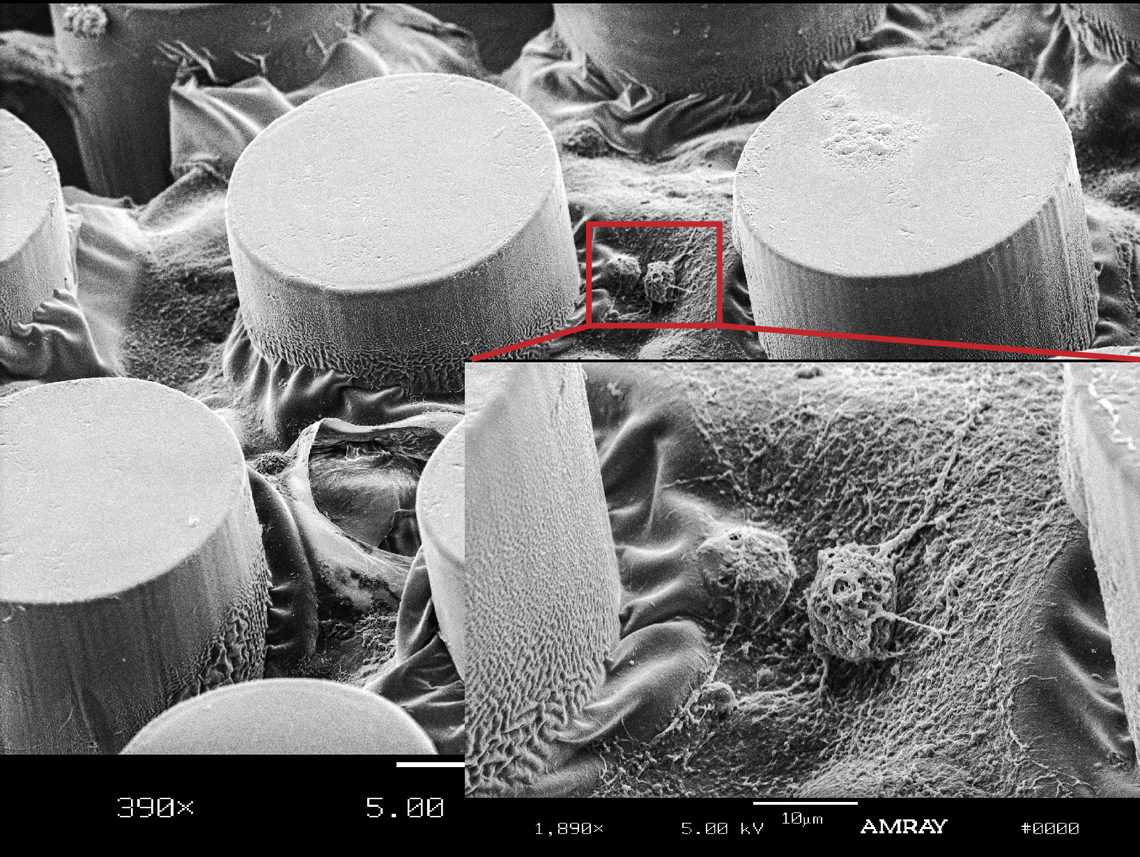 Electron microscopy shows cultured CTC cells (circled in red) growing on the chip device used in the study. Image credit: Jennifer Zhuo Zhang