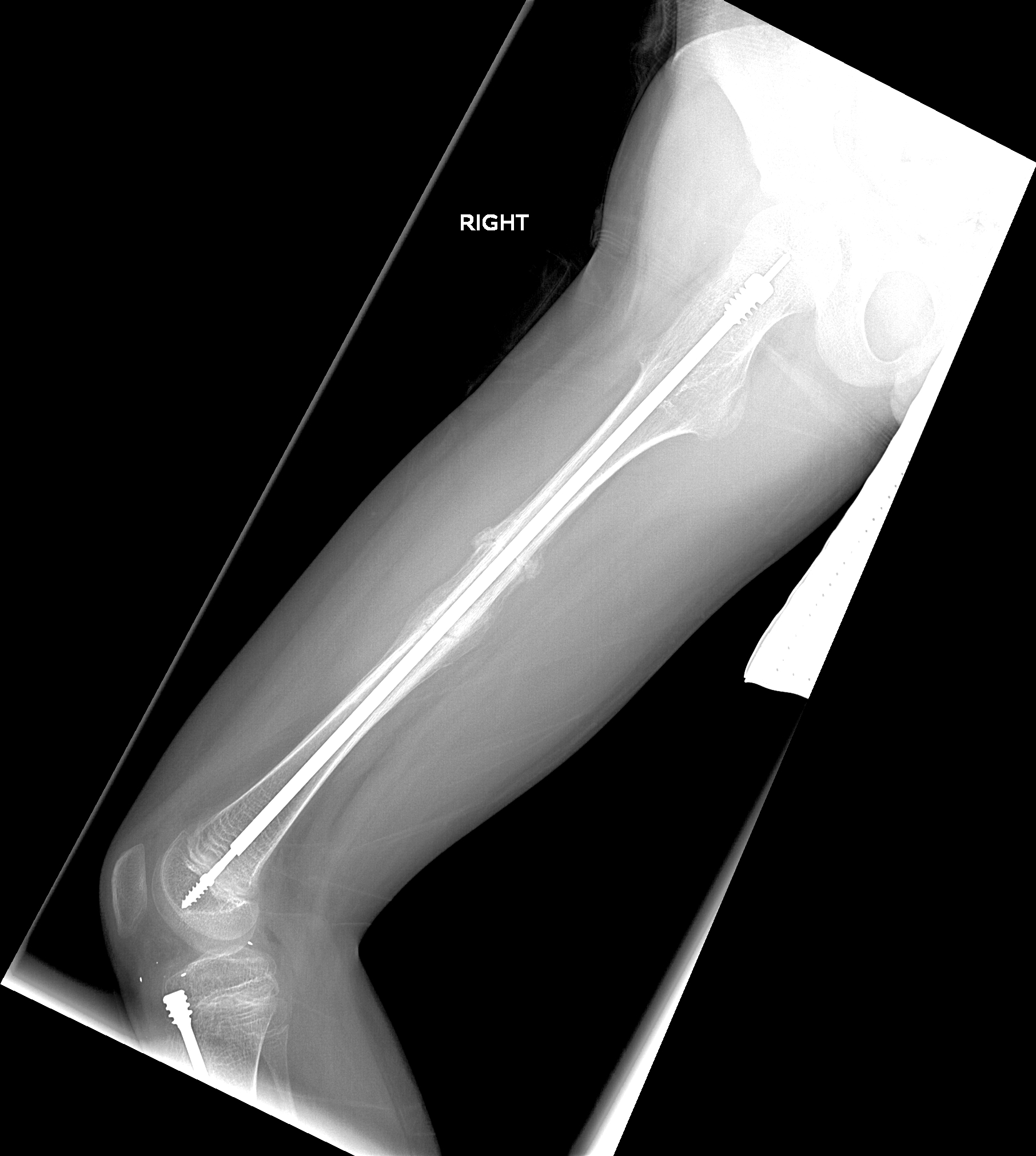 An X-ray image shows steel rods implanted in the femur (or leg bone) of a patient with brittle bone disease.  Image credit: Ken Kozloff