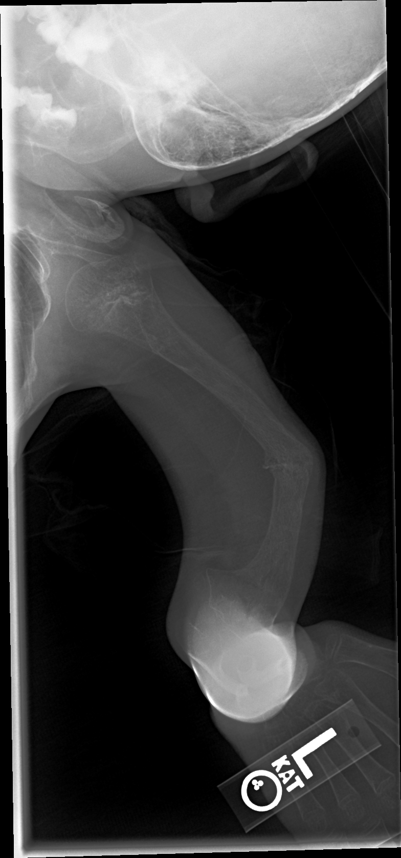 An X-ray image shows the bowed humerus (arm) bone of a patient with brittle bone disease. Image credit: University of Michigan Health System