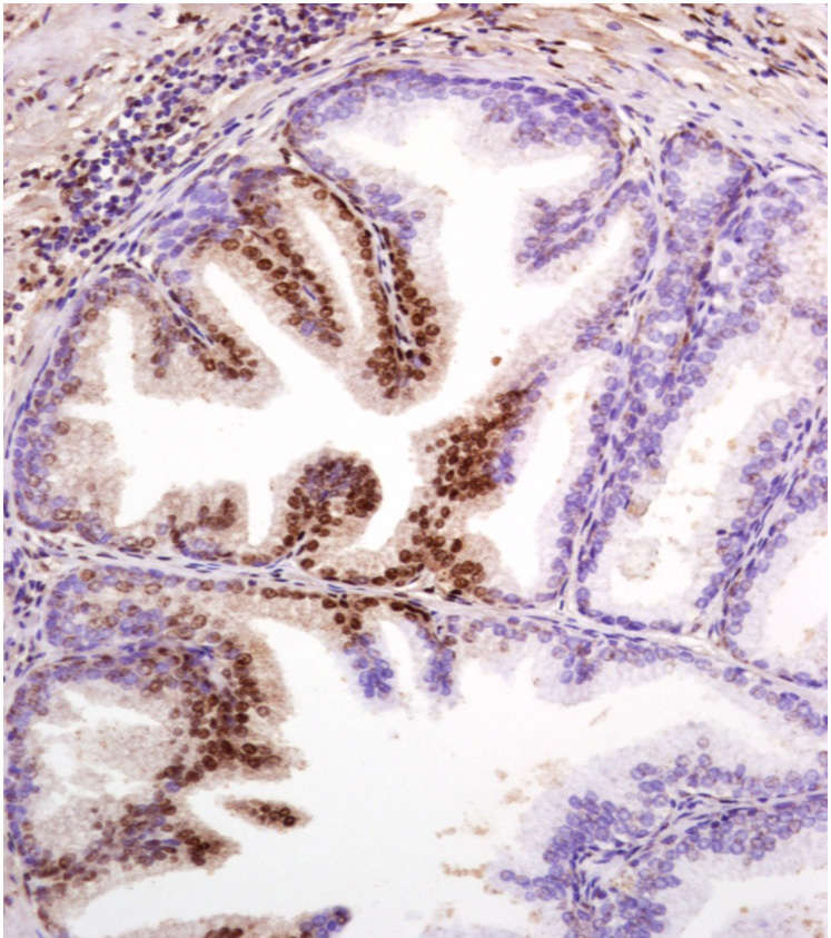 Tissue sample obtained in prostate cancer study. The cells stained brown show early prostate cancer, the blue stained cells indicate healthy cells. Image provided by Renny Franceschi, professor of Dentistry at the University of Michigan.