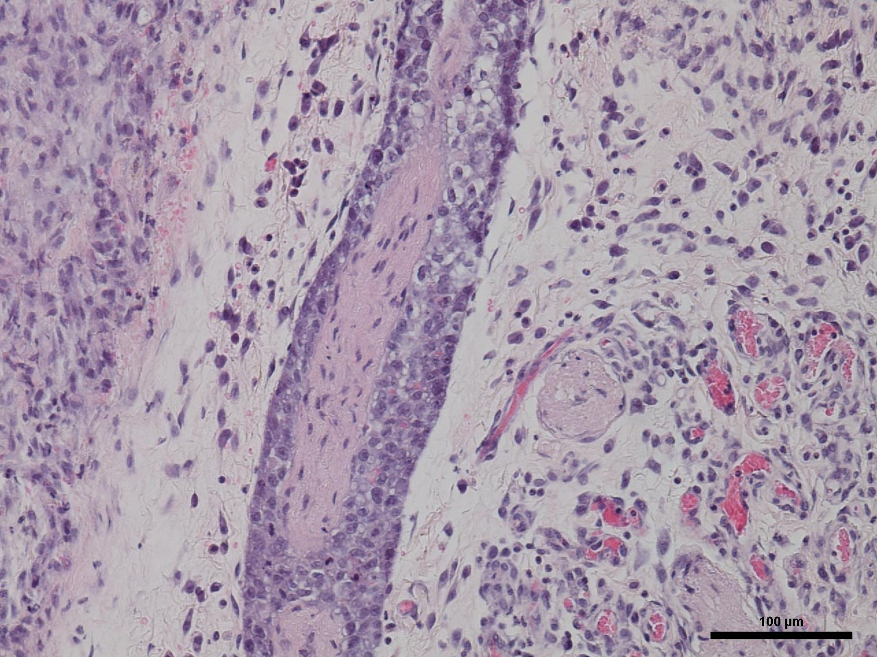The photomicrograph shows a nerve (central structure) invaded by cancer cells. Image credit: Nisha D’Silva