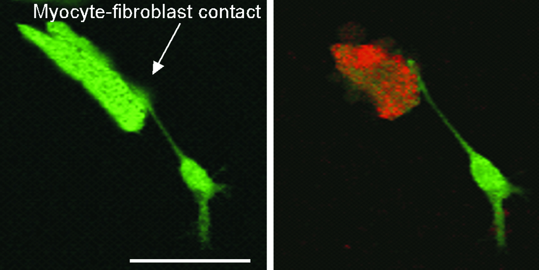 Microscopy photos show a cardiac myocyte cell (top) and an attached fibroblast cell (bottom) in a rat heart, after the injection of the newly developed nanoparticle. In the second frame, red light has been applied. The red coloring indicates that the myocyte, which causes cardiac arrhythmia, has been killed, while the fibroblast remains unharmed. Image credit: U.M.R. Avula et al., University of Michigan