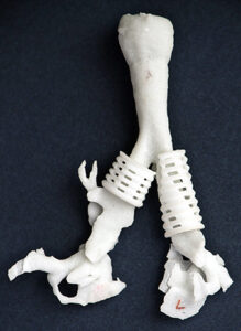 A 3D-printed tracheal splint has saved the lives of 4 children.