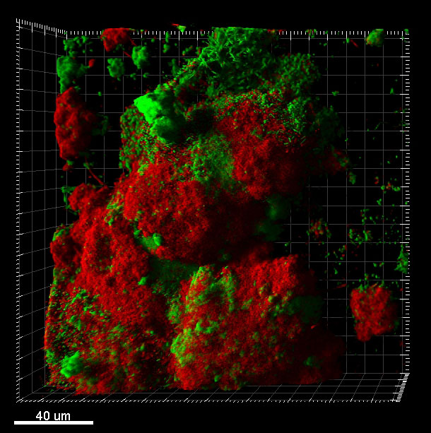 Nisin-treated oral biofilm. Image courtesy: Yvonne Kapila