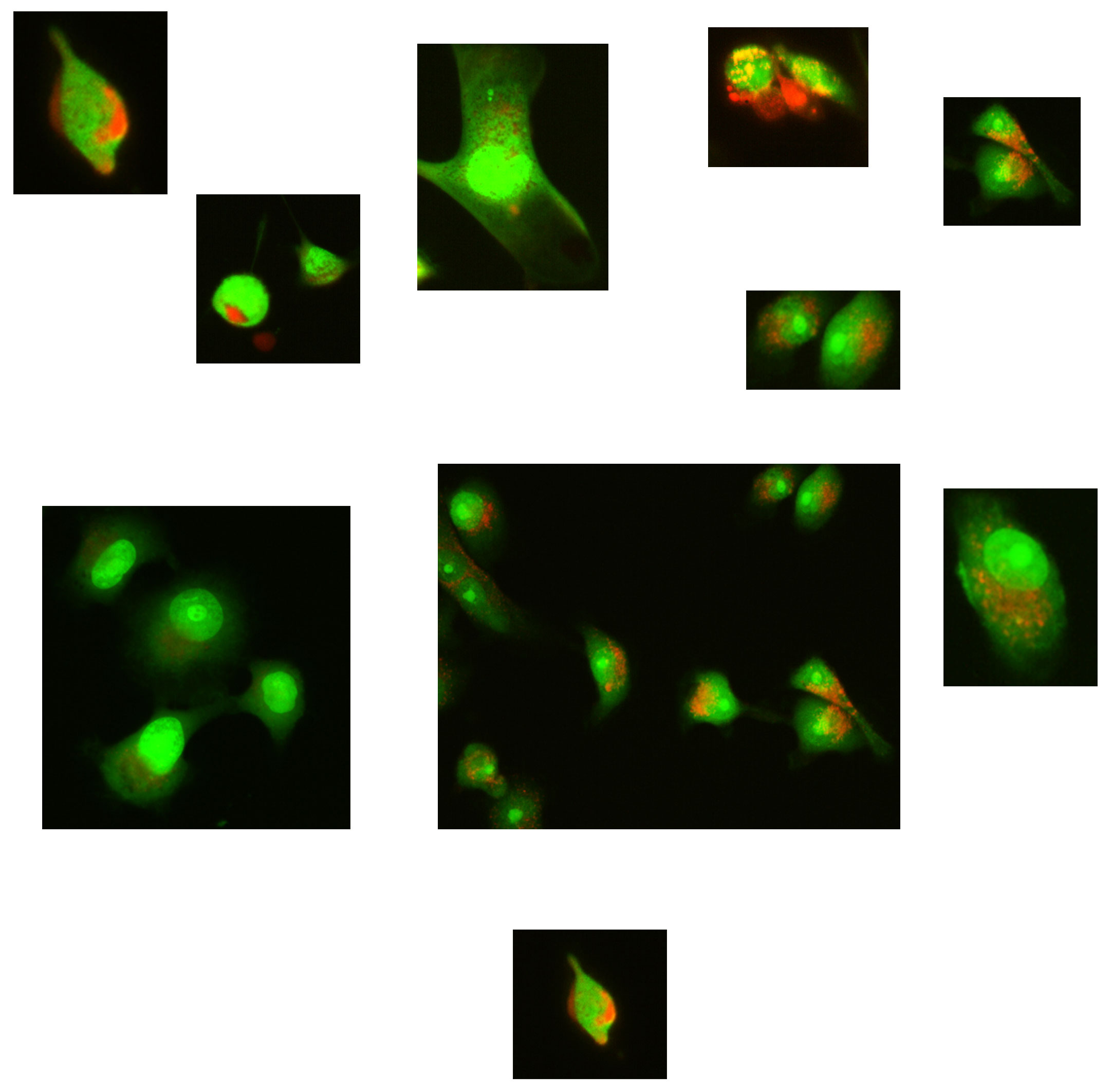 Nisin treated cancer cells in different doses. Image courtesy: Yvonne Kapila