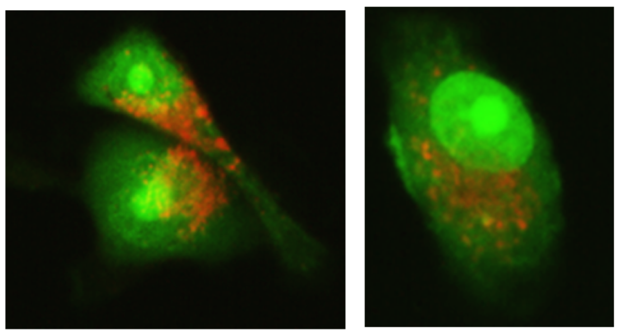 Oral cancer cells treated with Nisin and undergoing apoptotic cellular changes. Image courtesy: Yvonne Kapila