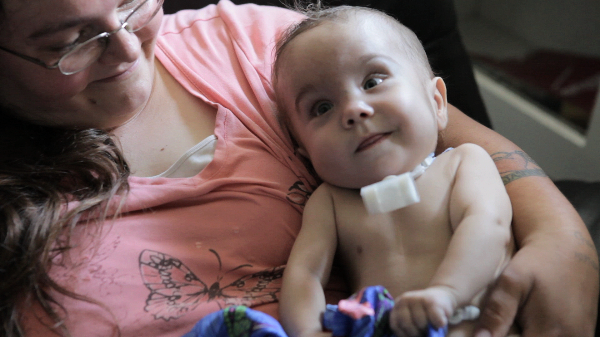 One of three babies who were the first in the world to be saved by a 3D printed device that held their airways open, allowing them to breathe.