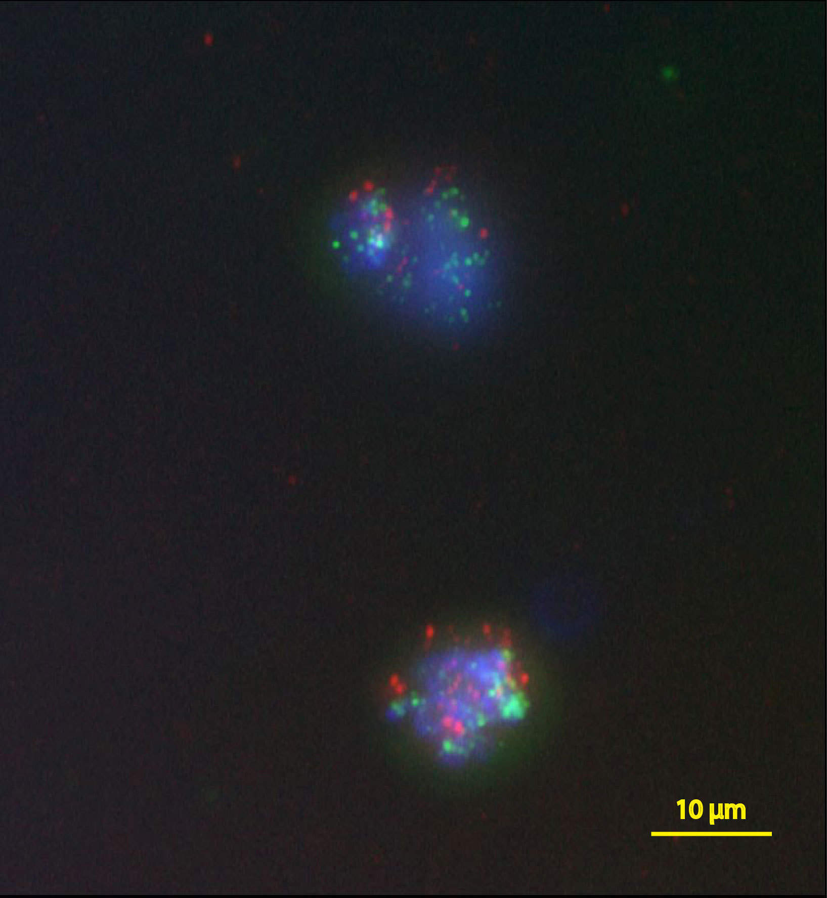 Fluorescence probes in two breast cancer cells give information about which genes are present. The green dots show that both cells have multiple copies of the HER2 gene, suggesting that the cancer is aggressive. Credit: Nallasivam Palanisamy, Henry Ford Health System. Copyright: Advanced Materials