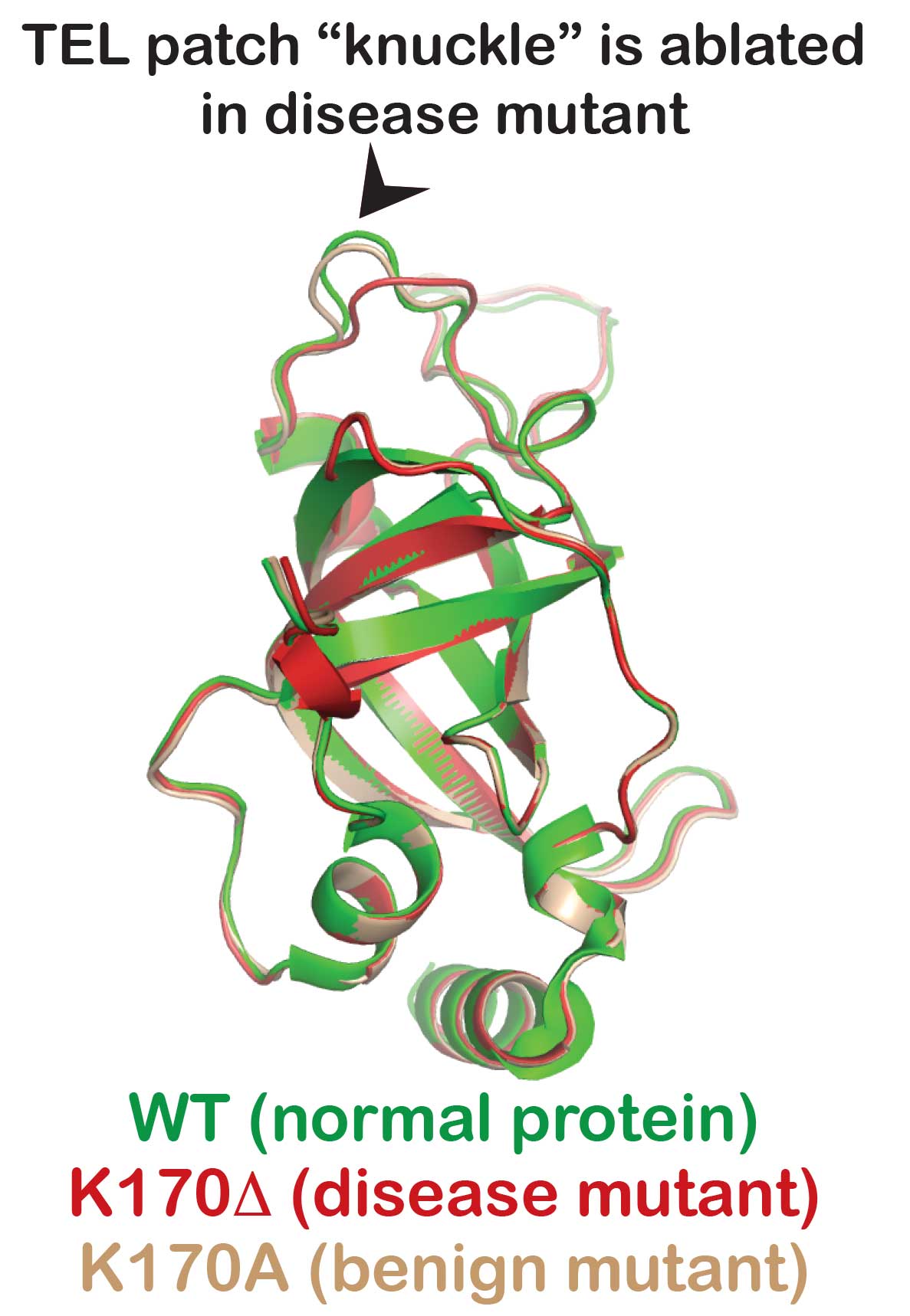 Overlay of three structures shows how a structural element called the "knuckle", which is critical for proper protein function, is disrupted in the disease mutant but not in the normal protein, or the benign mutant. Provided by the Nandakumar lab, University of Michigan