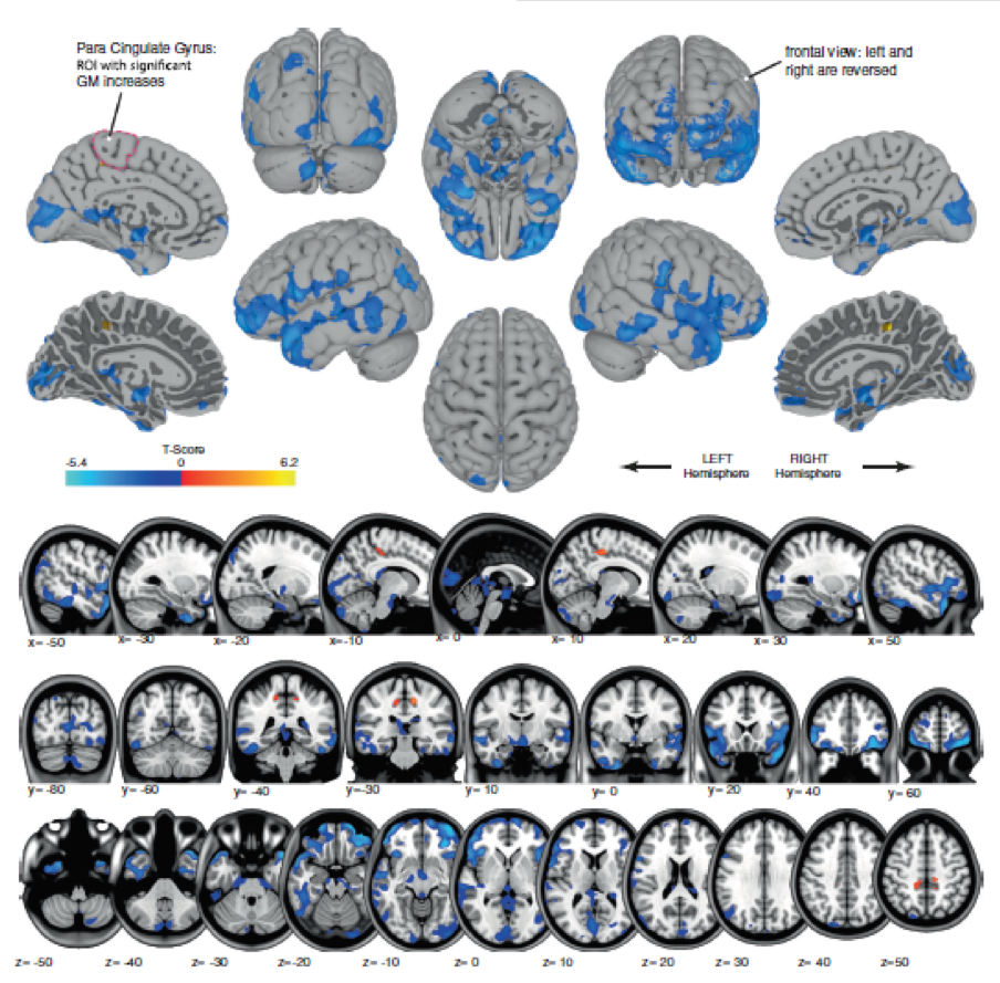 Blue shows areas of gray matter volume decrease, likely reflecting shifting of cerebrospinal fluid. Orange shows regions of gray matter volume increase, in the regions that control movement of the legs. This likely reflects brain plasticity associated with “learning how to move in microgravity”. This is the first image of how spaceflight changes brain structure in humans!