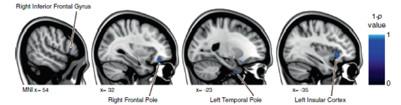 This figure shows dose response effects– blue areas are where there are more gray matter decreases in international space station astronauts than in those that just spent a few weeks on the space shuttle.