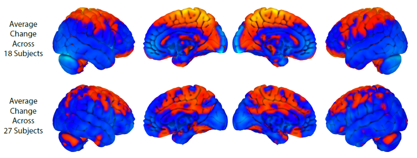 The top row shows brain changes with long duration bed rest; the bottom row shows brain changes with spaceflight. Orange shows regions of increase; blue = decrease. There is some overlap but also notable differences with spaceflight showing more changes in the cerebellum, a structure that is involved in motor learning.
