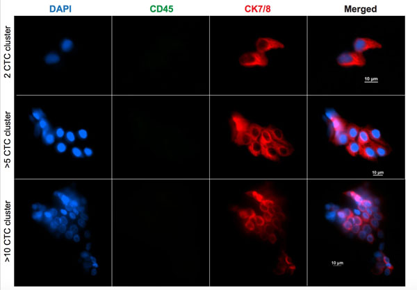 Cancer cell clusters, stained to prove that they are cancer cells. Cells in clusters showed signs of potentially aggressive traits. Credit: Vasudha Murlidhar, Nagrath Lab, University of Michigan