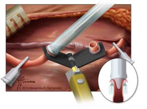 The arterial everter can help surgeons affix an artery to a separate tool in order to suture it. Image credit: © Alexandra B. Hernandez. For permission to use this illustration, please contact Alexandra Hernandez 