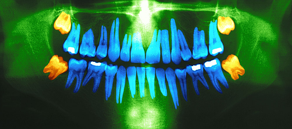 Dental panoramic x-ray. In orange,the wisdom teeth. Image courtesy: IHPI