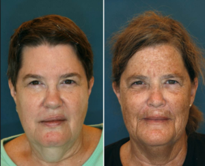 Identical twins; one smoked for 16 years longer than the other. Can you guess who the smoker is? Source: Plastic and Reconstructive Surgery 2013;132(5).