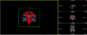 Computer recreation of patient MRI scans, abnormalities are undetectable with the naked eye. Red depicts the right side corticospinal tract, blue depicts the left. Image credit: Adam Lepley