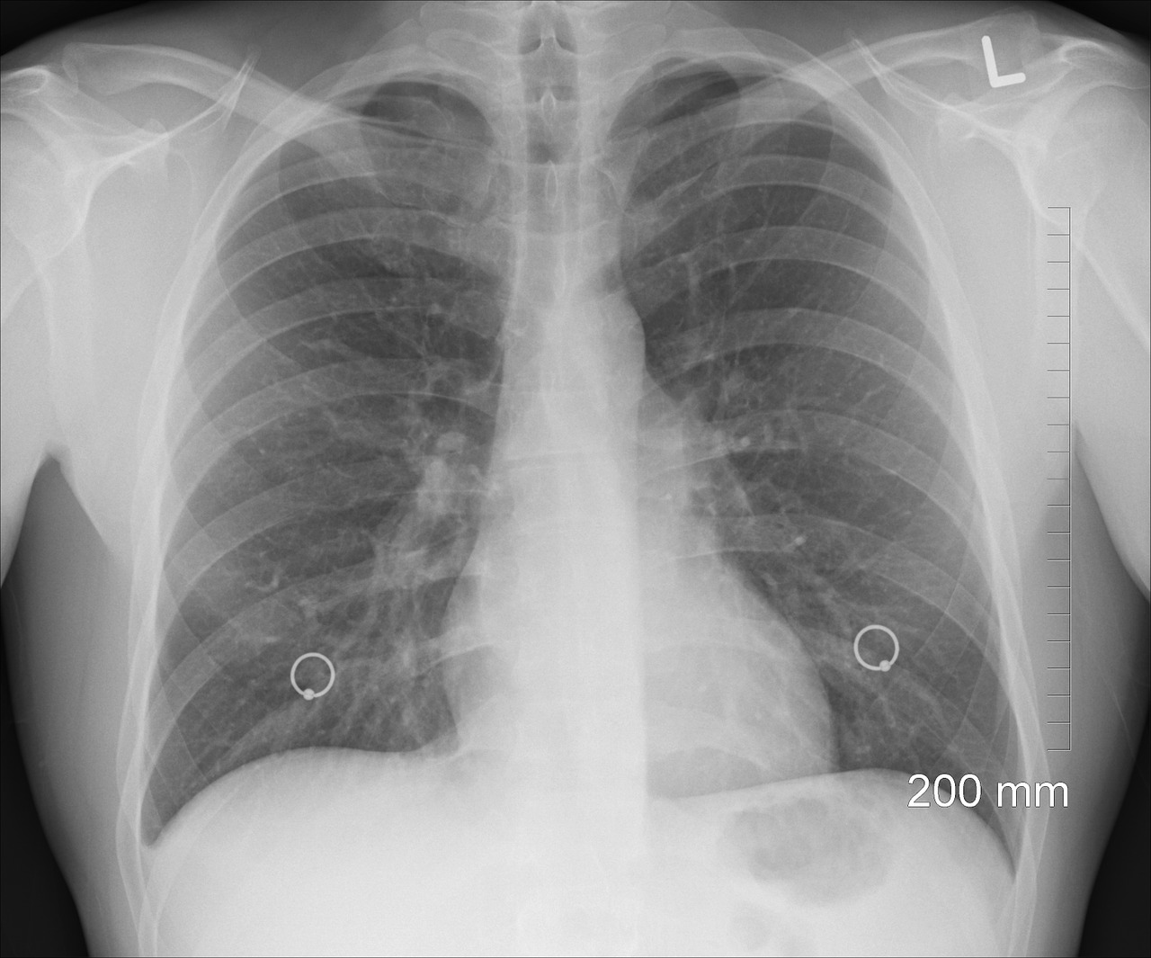 Photo of a chest x-ray. Image credit: Pixabay