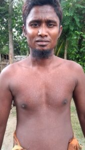 Chronic arsenic exposure is associated with skin lesions, cancers of the liver, lung, bladder and skin, pulmonary disease, neurological disorders, and cardiovascular disease. In this image a resident of Arardah village is showing visible signs of arsenical keratosis. Image credit: R. Reddy