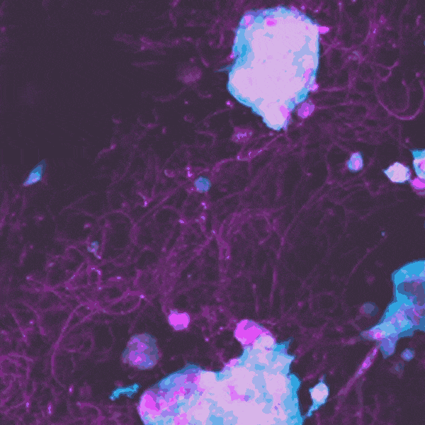 Timelapse of lung fibroblasts (blue) migrating and remodeling matrix fibers that mimic lung collagen (magenta) over 24 hours. When fibroblasts are able to remodel their environment, they can turn into disease-promoting myofibroblasts in 3d. Image credit: Baker Lab