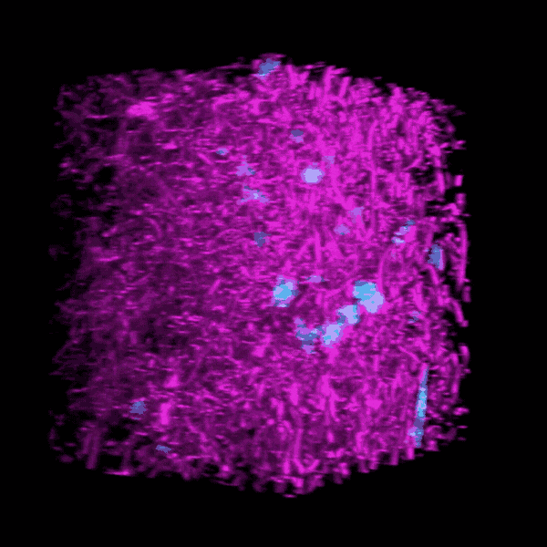 The 3-D lung connective tissue model showing lung fibroblasts (blue) within matrix fibers mimicking lung collagen (magenta). Image credit: Baker Lab