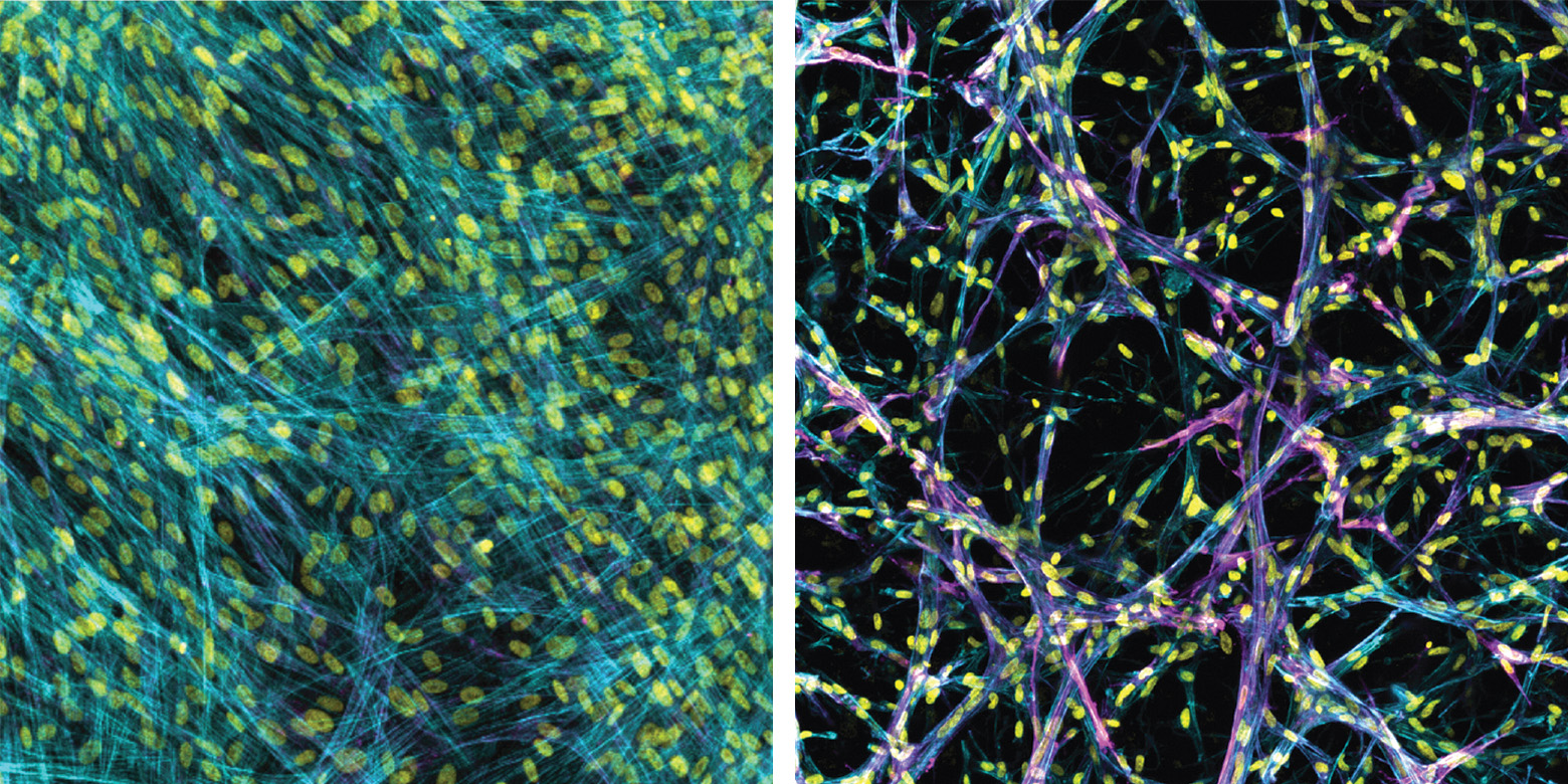 In line with prior work, myofibroblasts fail to accumulate in soft 2D settings (left). In the new 3d model (right) the myofibroblasts (magenta) accumulate, even in soft conditions that mimic a healthy lung. Images are stained for cytoskeleton (blue), cell nuclei (yellow), and a marker for myofibroblast activation (alpha-smooth muscle actin, magenta). Image credit: Baker Lab