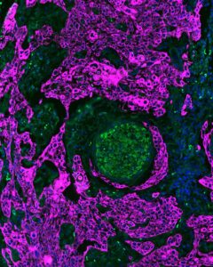 Microscopic image of a tongue tumor depicting cancer cells in magenta and a nerve in green. Cancer cells encircle the nerve, a feature known as perineural invasion. Image credit: D'silva lab