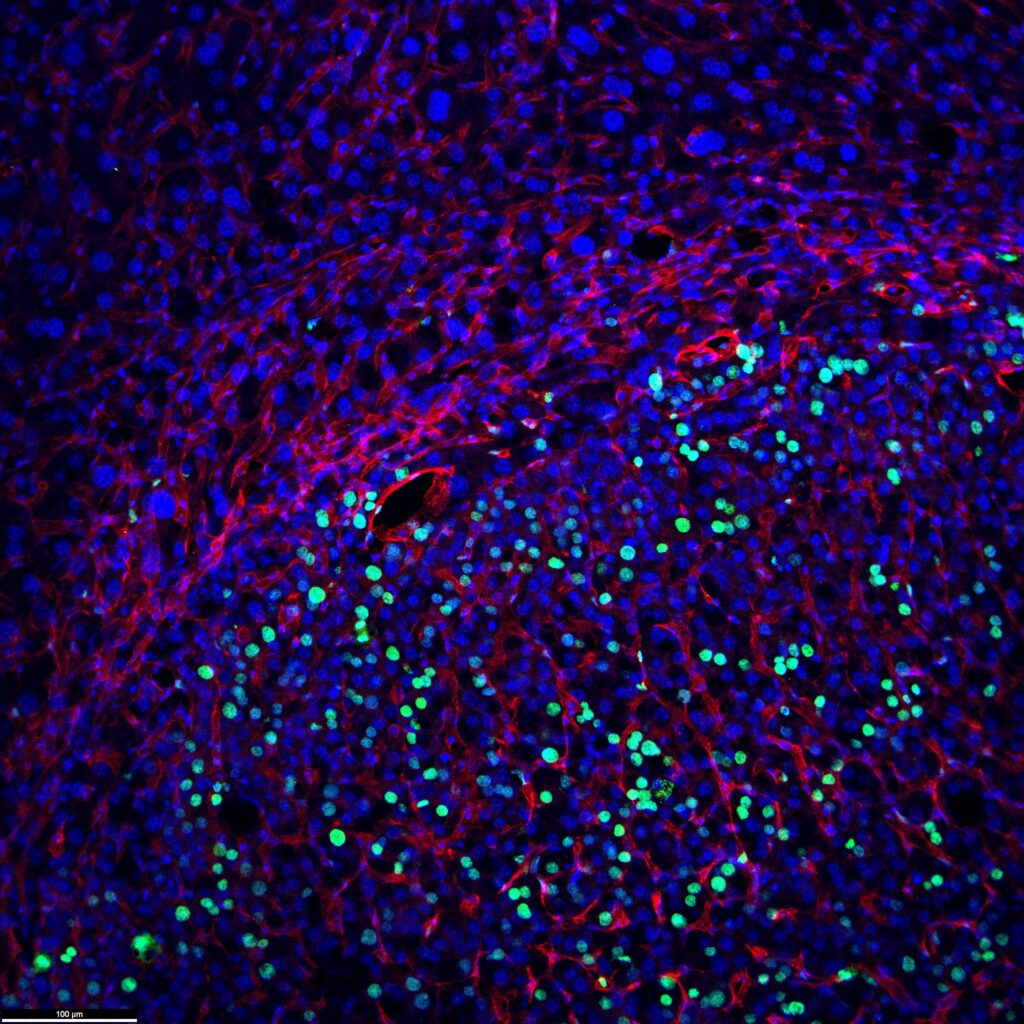 Normal liver tissue (top) and a liver cancer nodule (bottom) containing many dividing cells (labeled in green). Red color indicates blood vessels. Image credit: Jiandie Lin, Life Sciences Institute