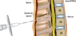 Injection into spine