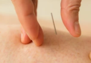 acupuncture needles in skin