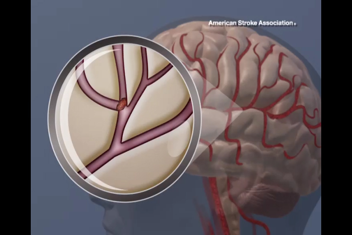 A blood clot in the brain. Image credit: American Heart Association