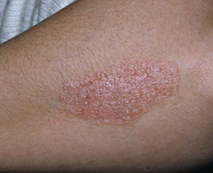 An upclose image of psoriasis on human skin. Red, raised patch.