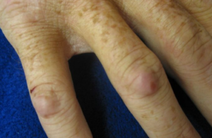Swollen joints due to RA